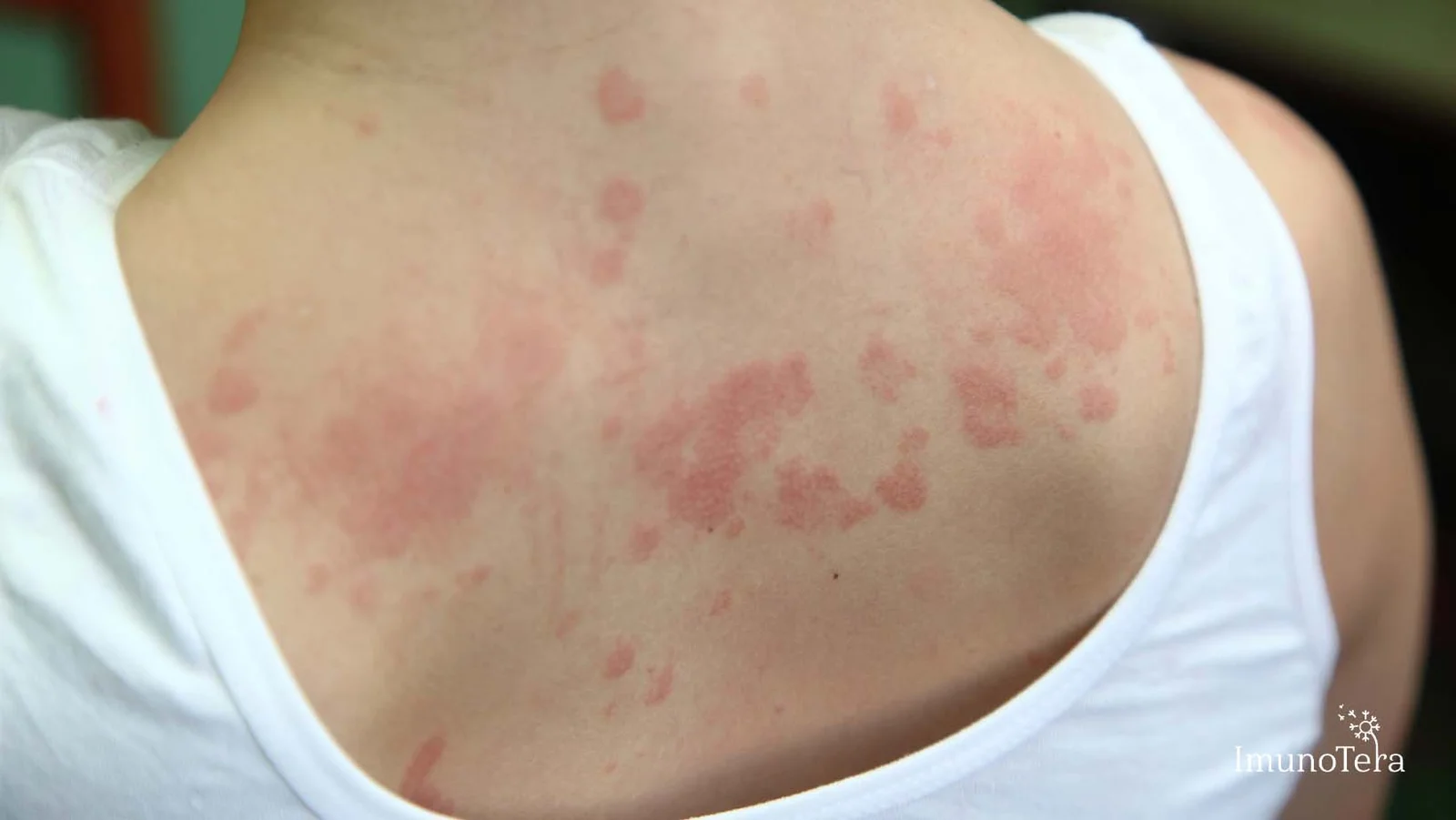 Atipinis dermatitas arba reito ir lėto tipo alerginės reakcijos