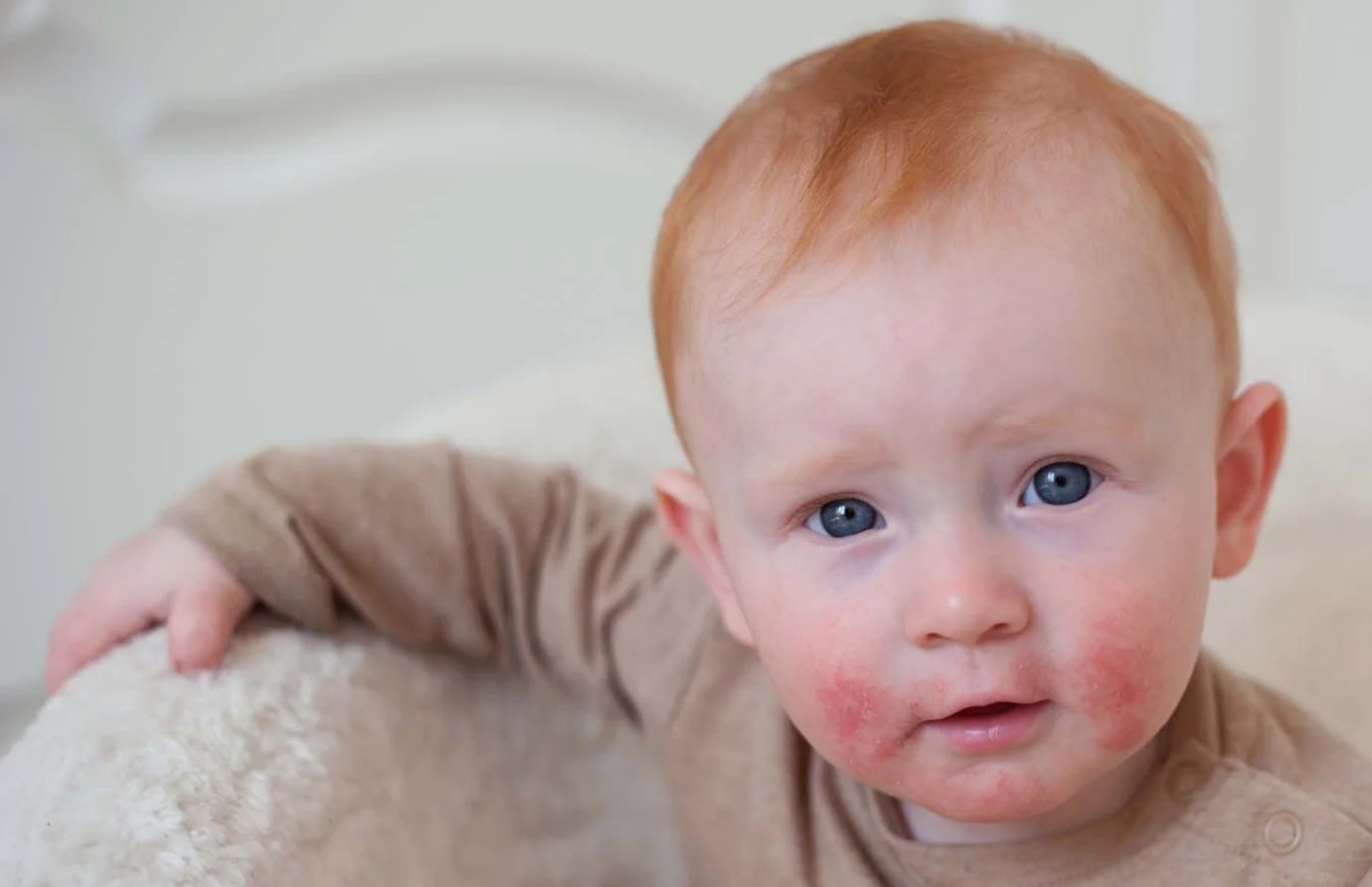 Atopinis dermatitas – ar visada alergija