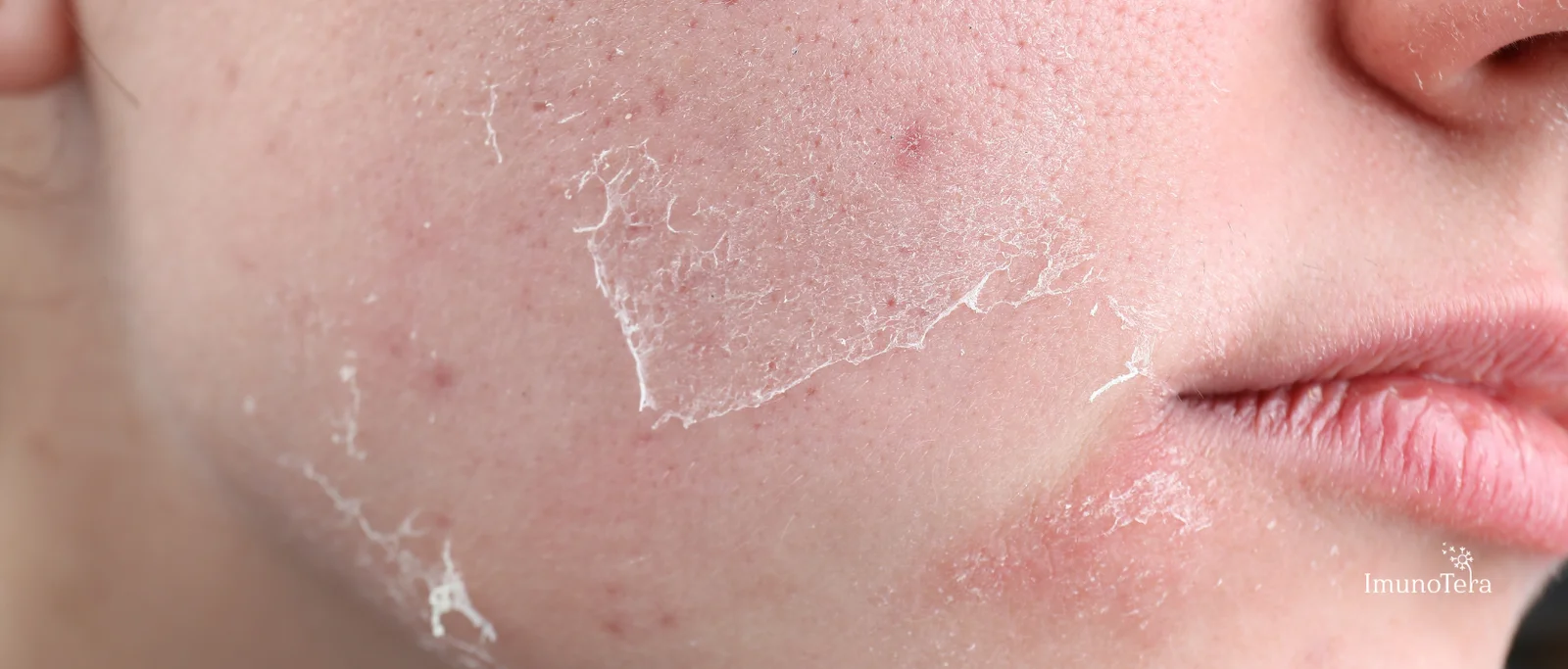 Apsaugos nuo saulės ypatumai jautrios odos savininkams