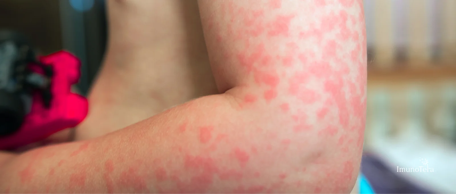 Jautrumas saulei (fotojautrumas) arba „alergija saulei“