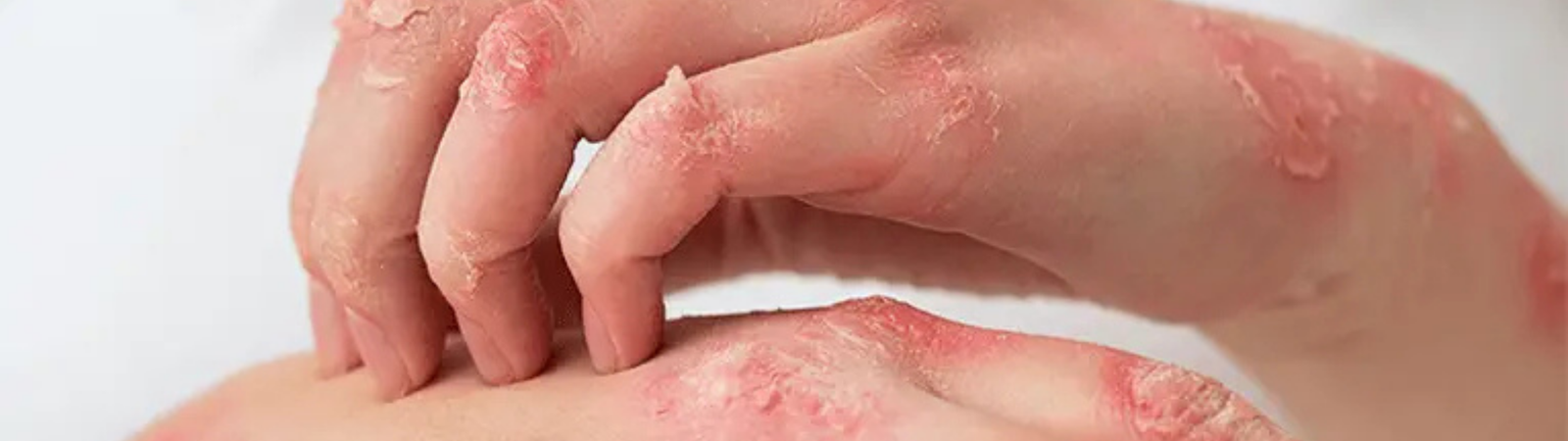 Alerginis kontaktinis dermatitas arba kontaktinė alergija: kai užtenka lašo