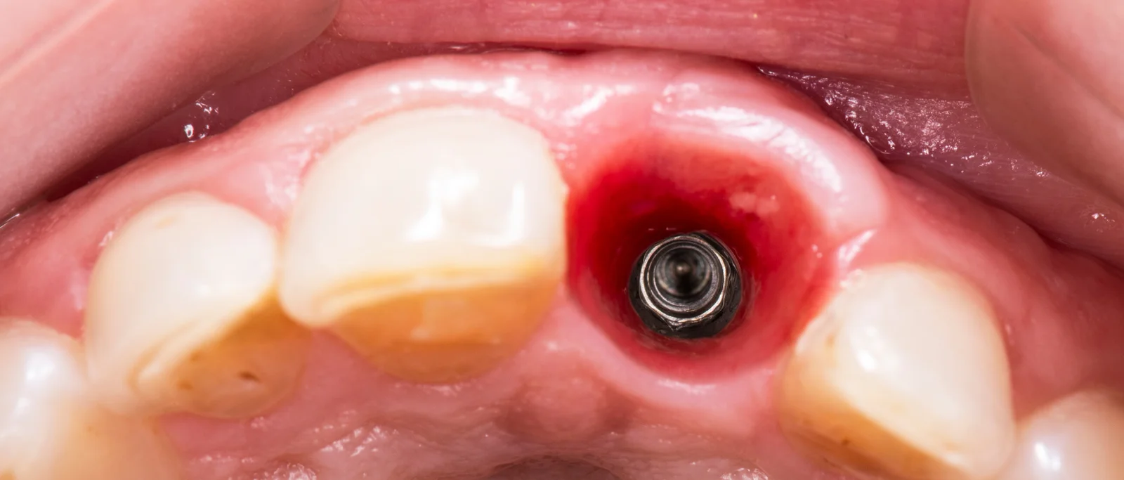 Pasitikrinkite dėl kontaktinės alergijos jau dabar. Išplėstinis odos lopo tyrimas su 34 ODONTOLOGINIAIS alergenais tik ImunoTera klinikoje Vilniuje