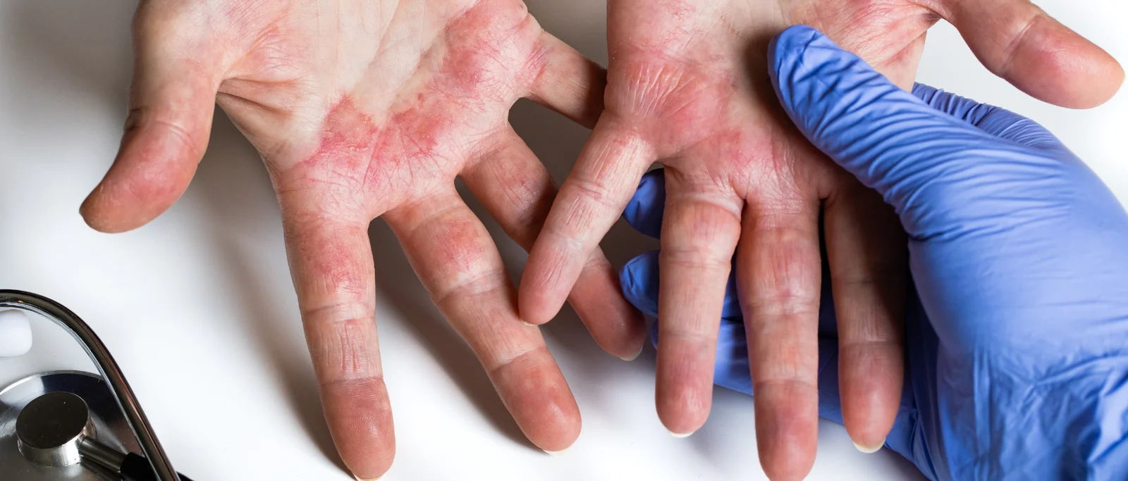 Alergija plaukų produktams