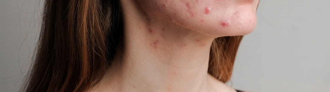 Alergija kiaušiniams simptomai, tyrimai, gydymas