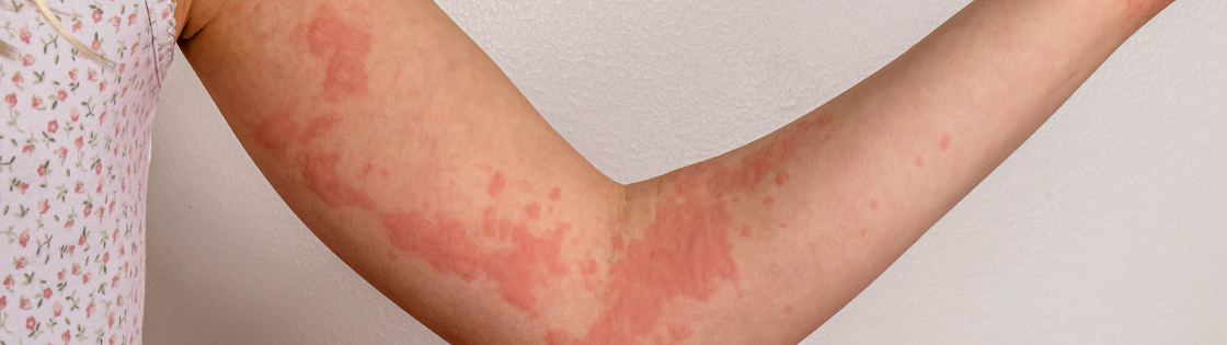 Alergija kviečiams kviečių sukelta kontaktinė dilgėlinė