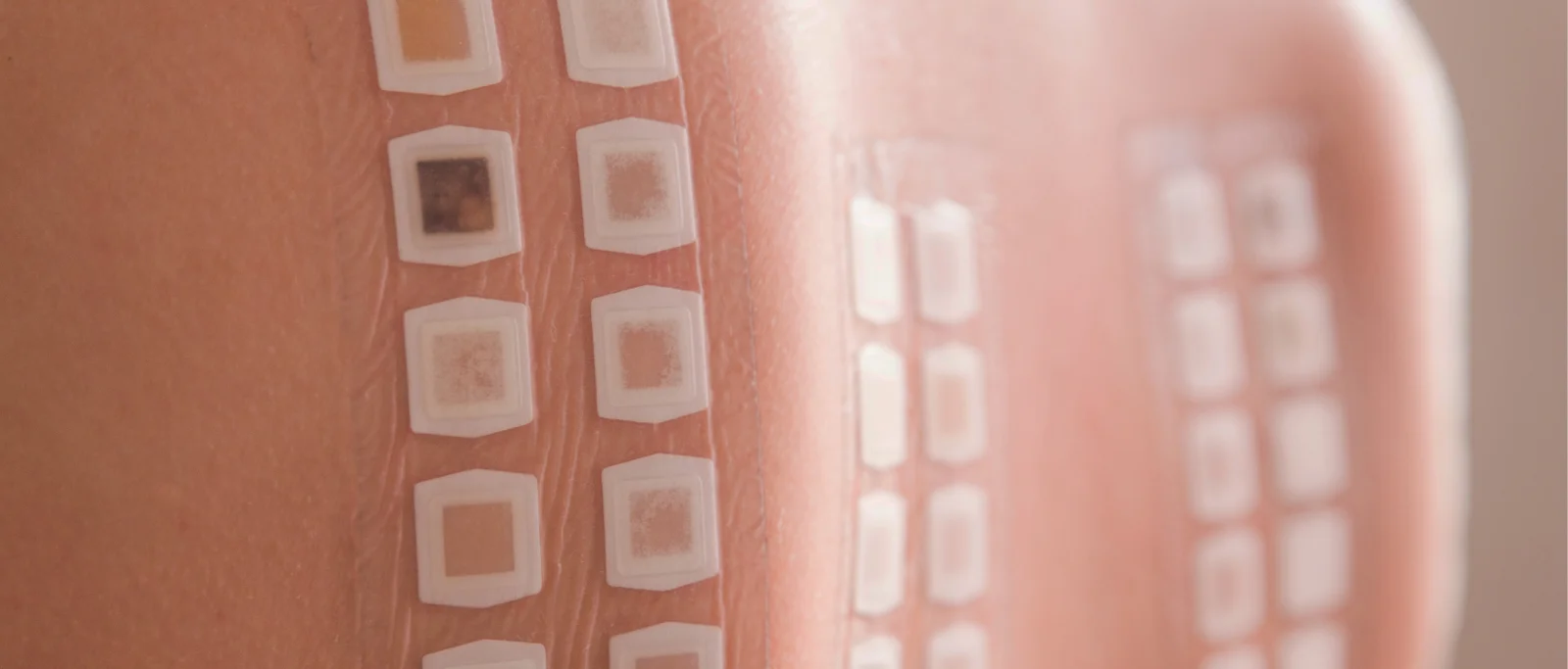 Kada reikia atlikti alerginius odos lopo mėginius odontologinėms priemonėms